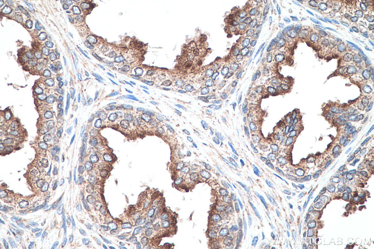 IHC staining of human prostate cancer using 67159-1-Ig