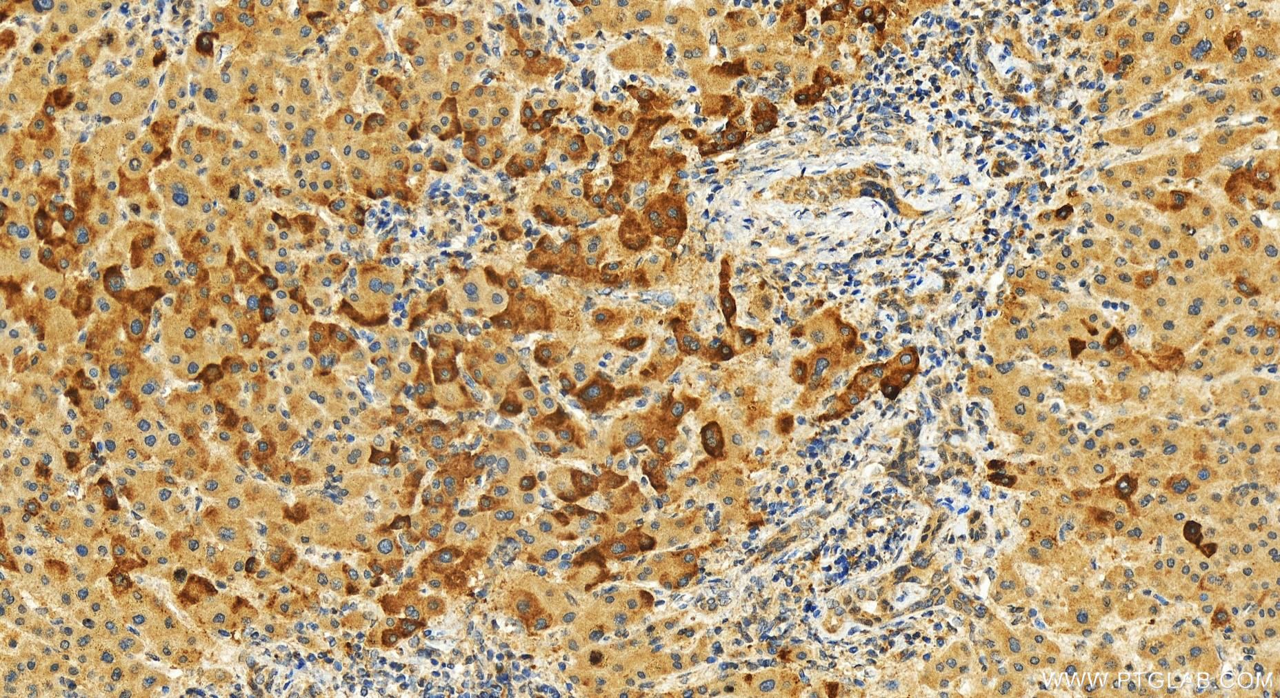 IHC staining of human intrahepatic cholangiocarcinoma using 19118-1-AP