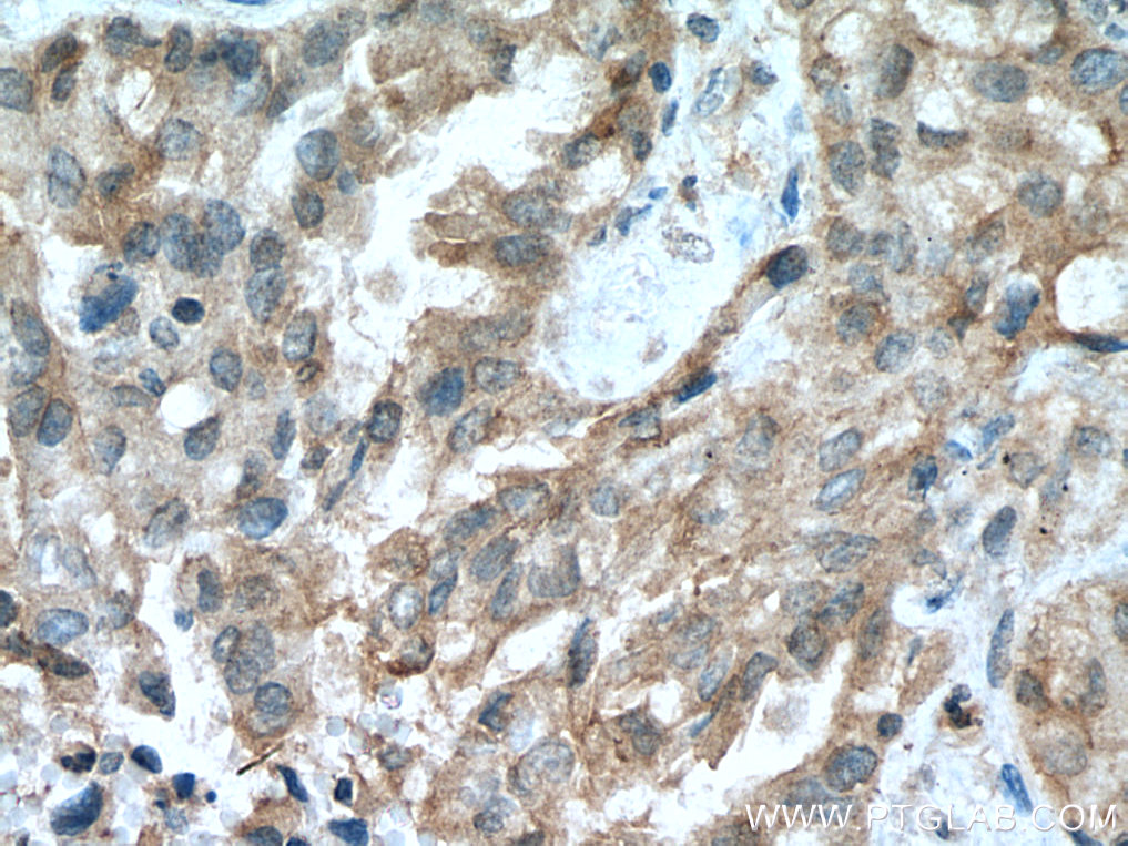 IHC staining of human lung cancer using 21753-1-AP