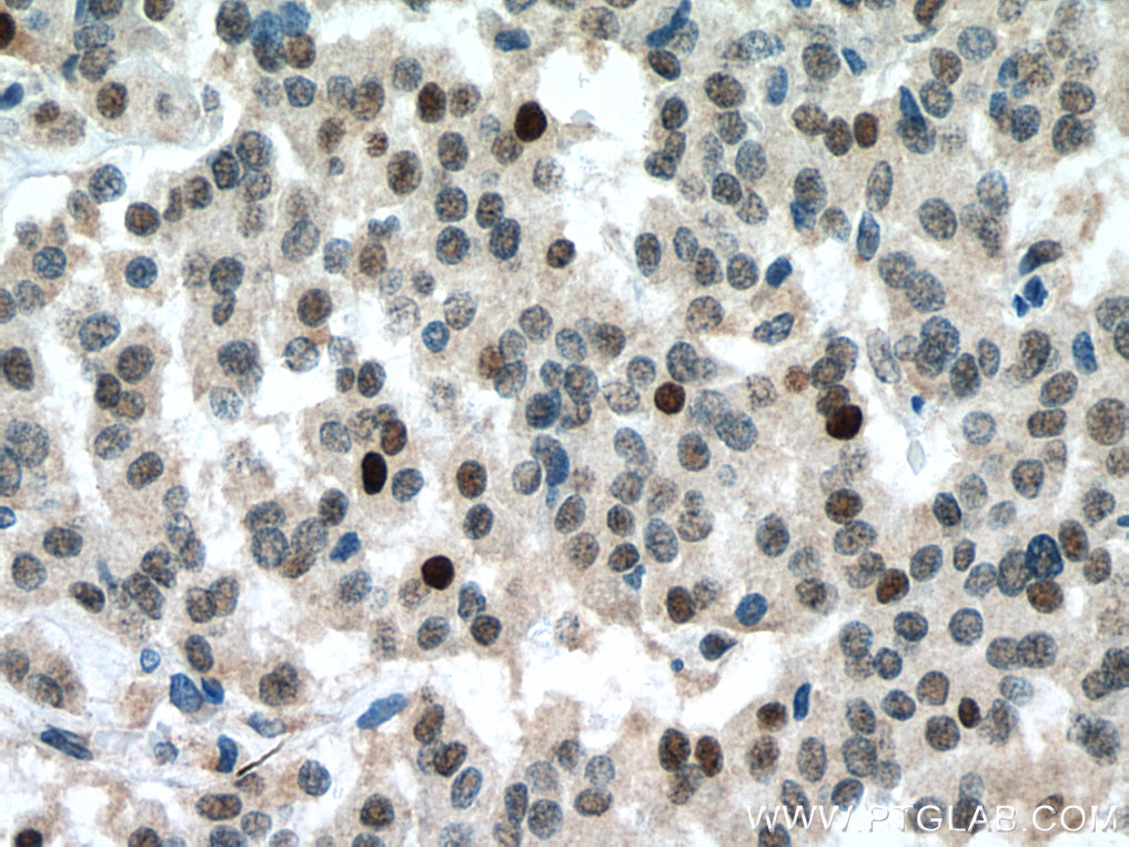 IHC staining of Insulinoma using 67521-1-Ig