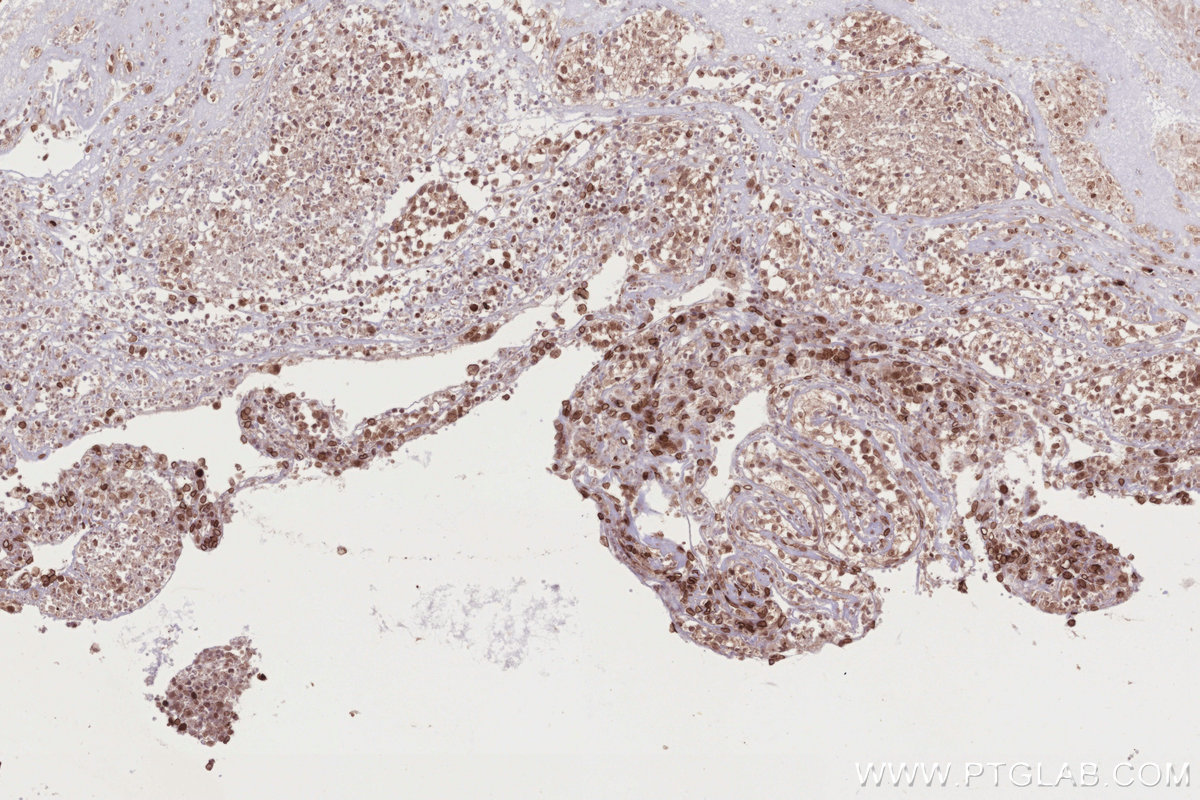 IHC staining of human ovary cancer using 84757-3-RR IHC staining of human ovary cancer using 84757-3-RR