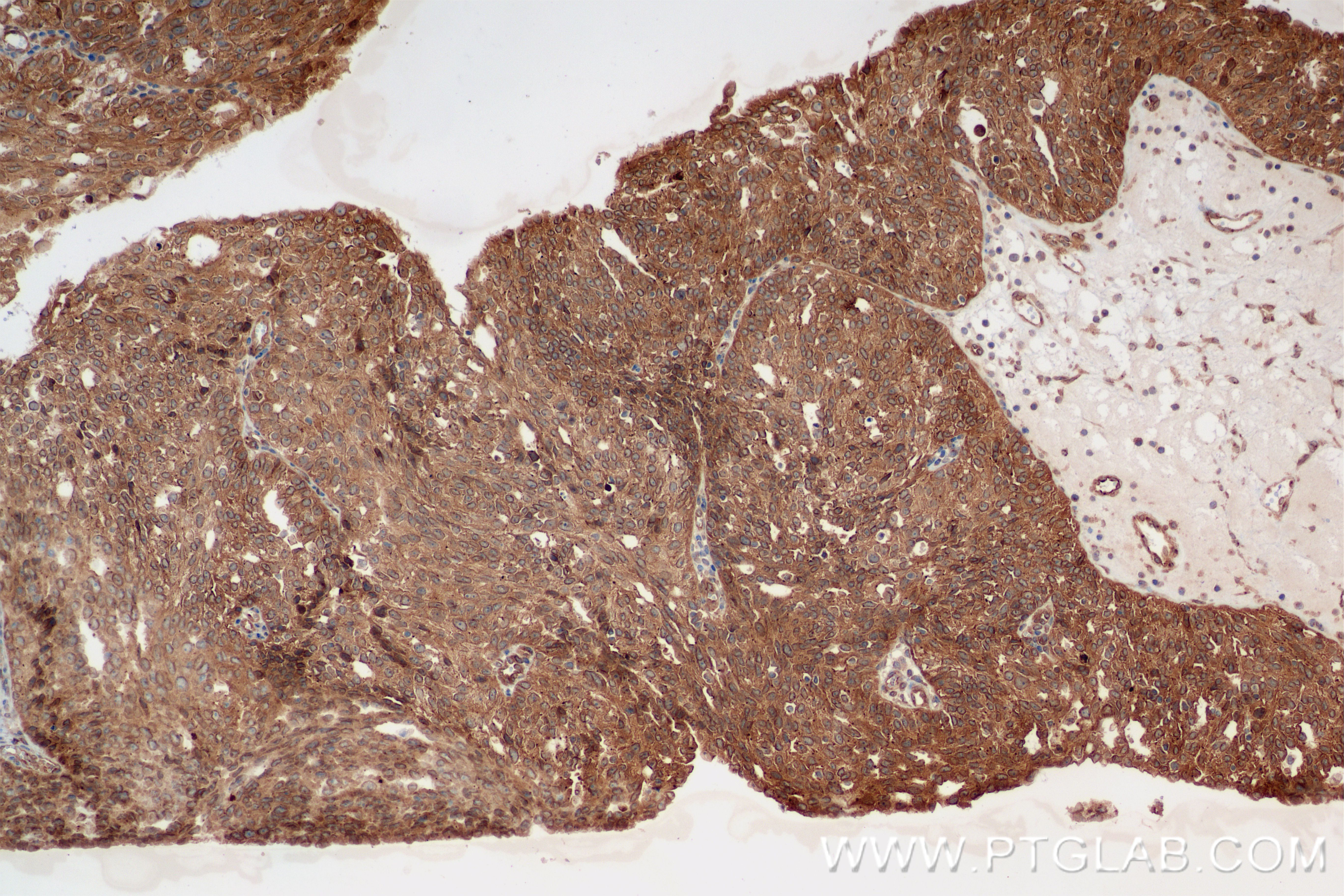 IHC staining of human ovary cancer using 84757-3-RR (same clone as 84757-3-PBS)