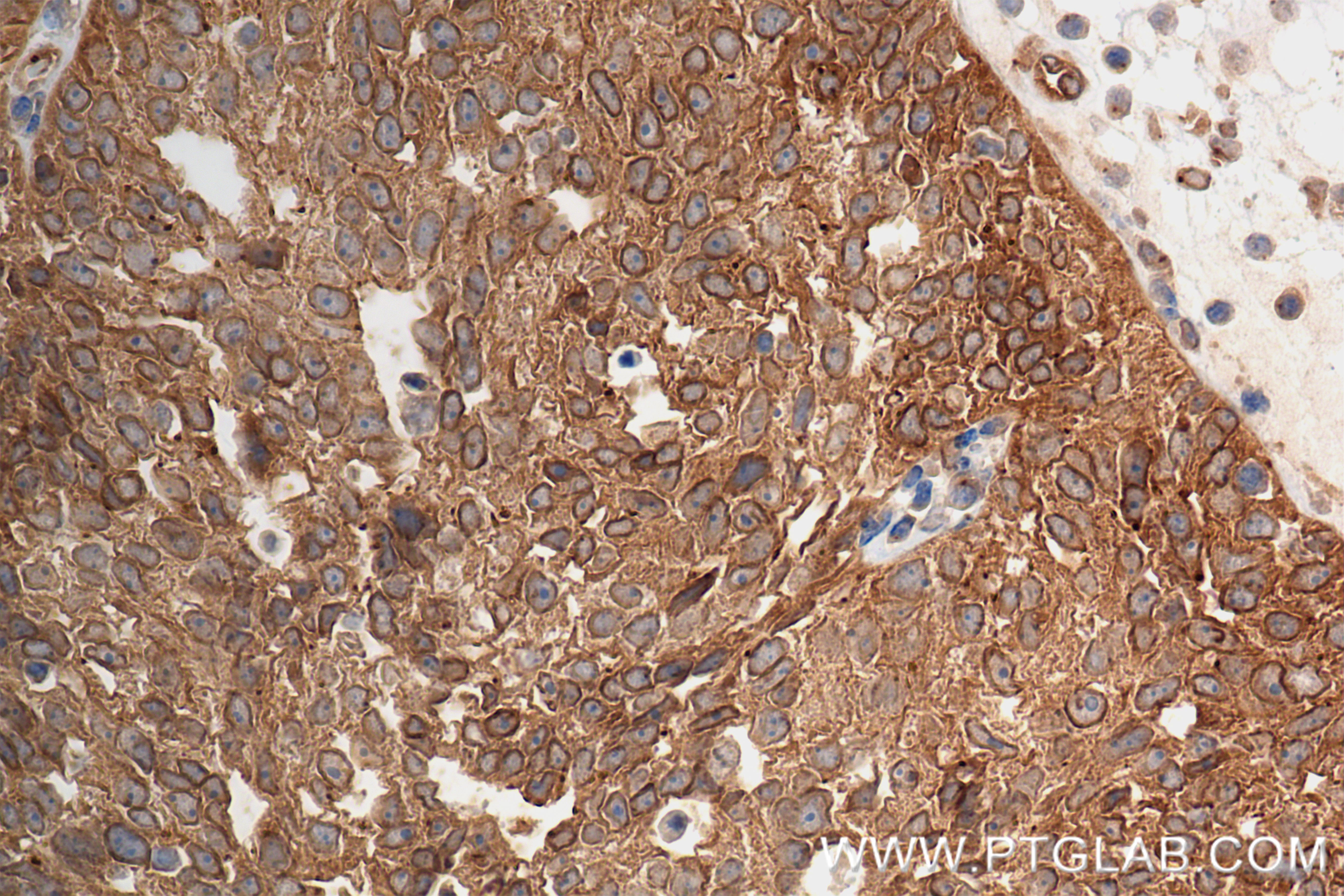 IHC staining of human ovary cancer using 84757-3-RR (same clone as 84757-3-PBS)