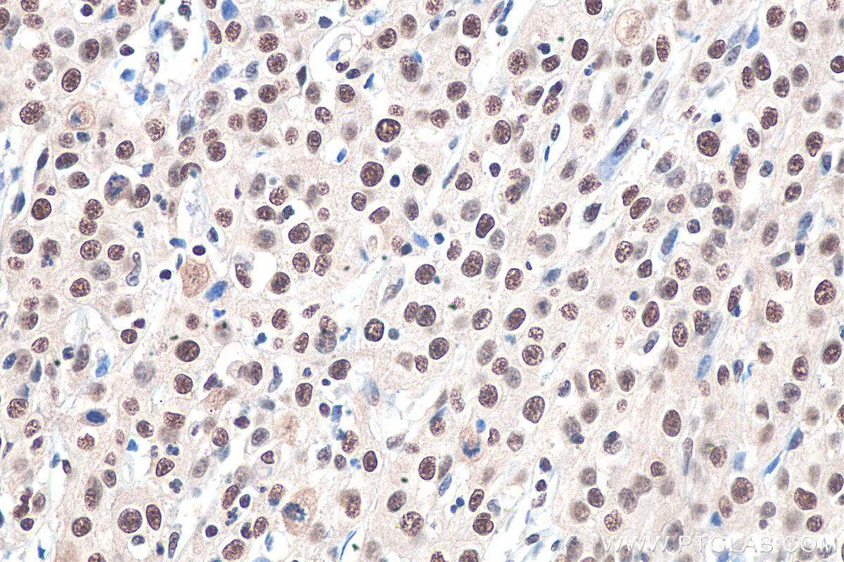 IHC staining of human cervical cancer using 20364-1-AP