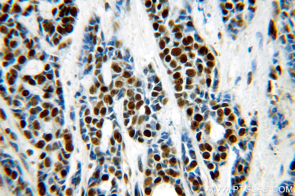 IHC staining of human cervical cancer using 20364-1-AP