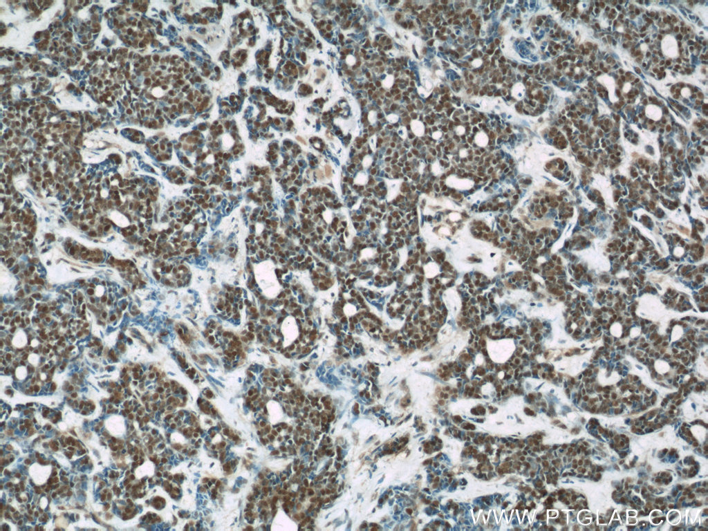 IHC staining of human cervical cancer using 66060-1-Ig