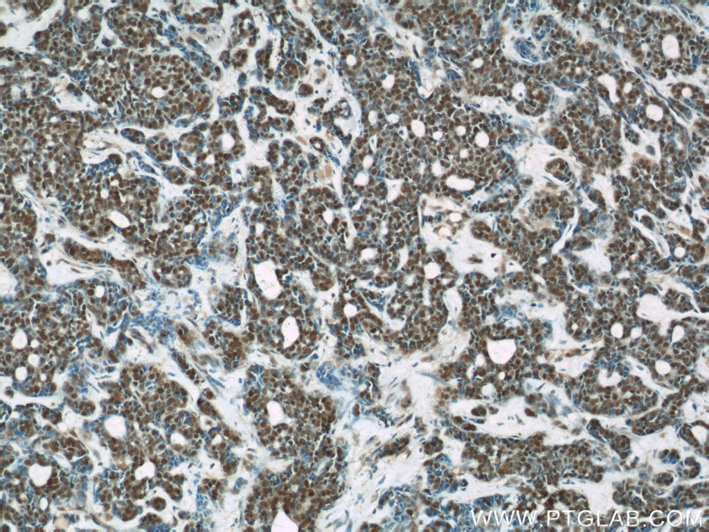 IHC staining of human cervical cancer using 66060-1-Ig (same clone as 66060-1-PBS)