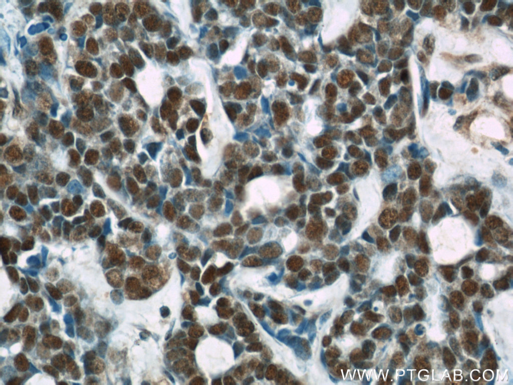 IHC staining of human cervical cancer using 66060-1-Ig (same clone as 66060-1-PBS)