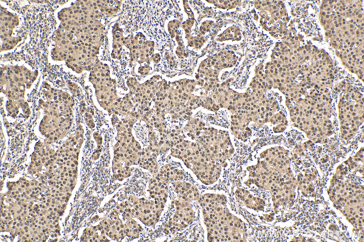 IHC staining of human breast cancer using 20365-1-AP