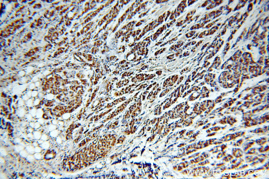 IHC staining of human cervical cancer using 20365-1-AP