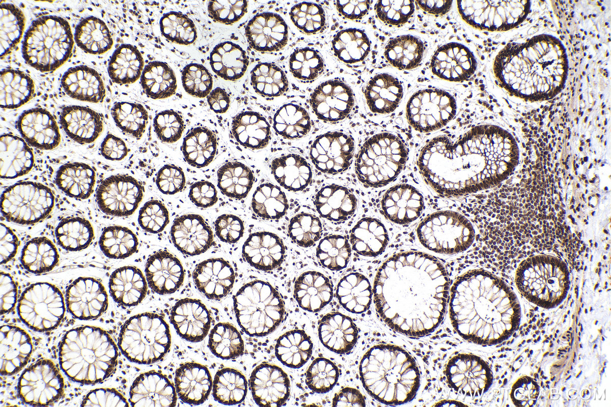 IHC staining of human rectal cancer using 84330-1-RR