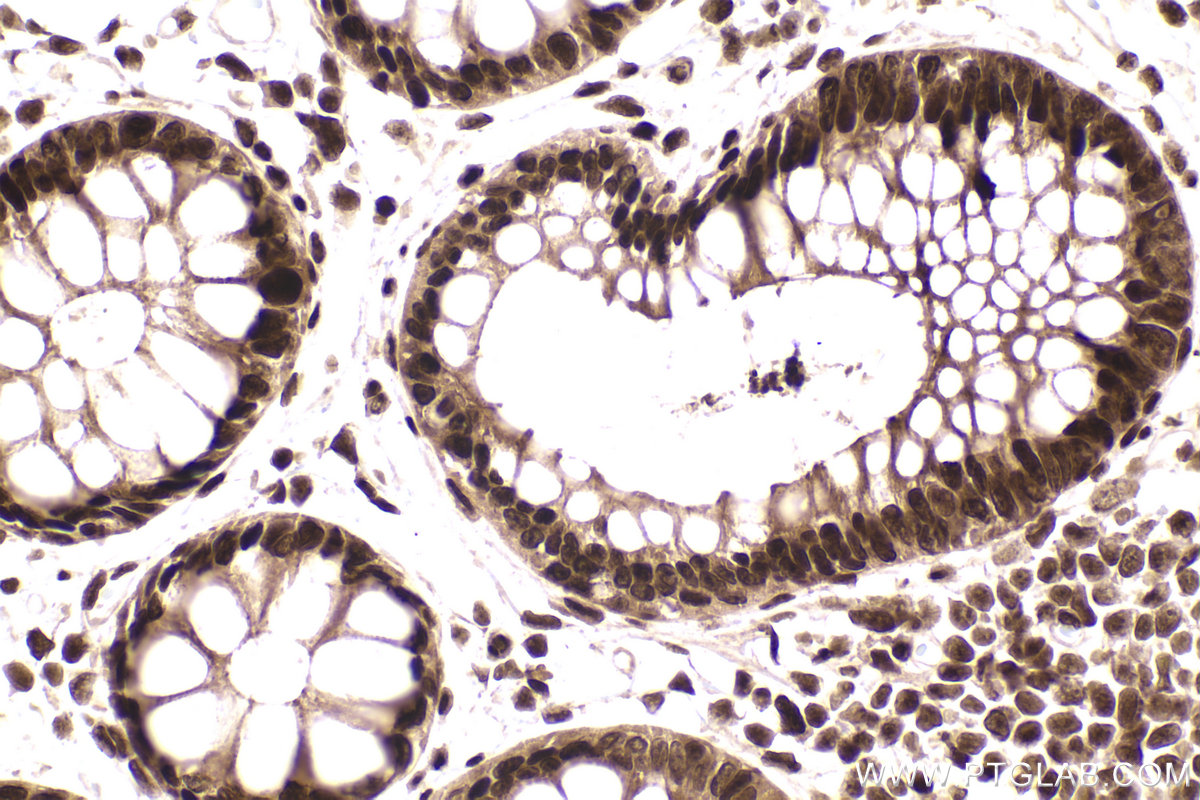 IHC staining of human rectal cancer using 84330-1-RR