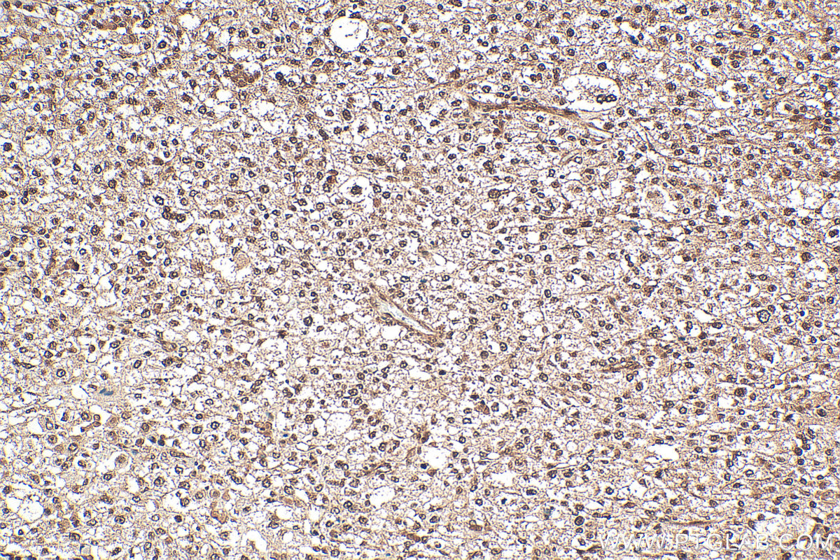 IHC staining of human pancreas cancer using 12230-2-AP