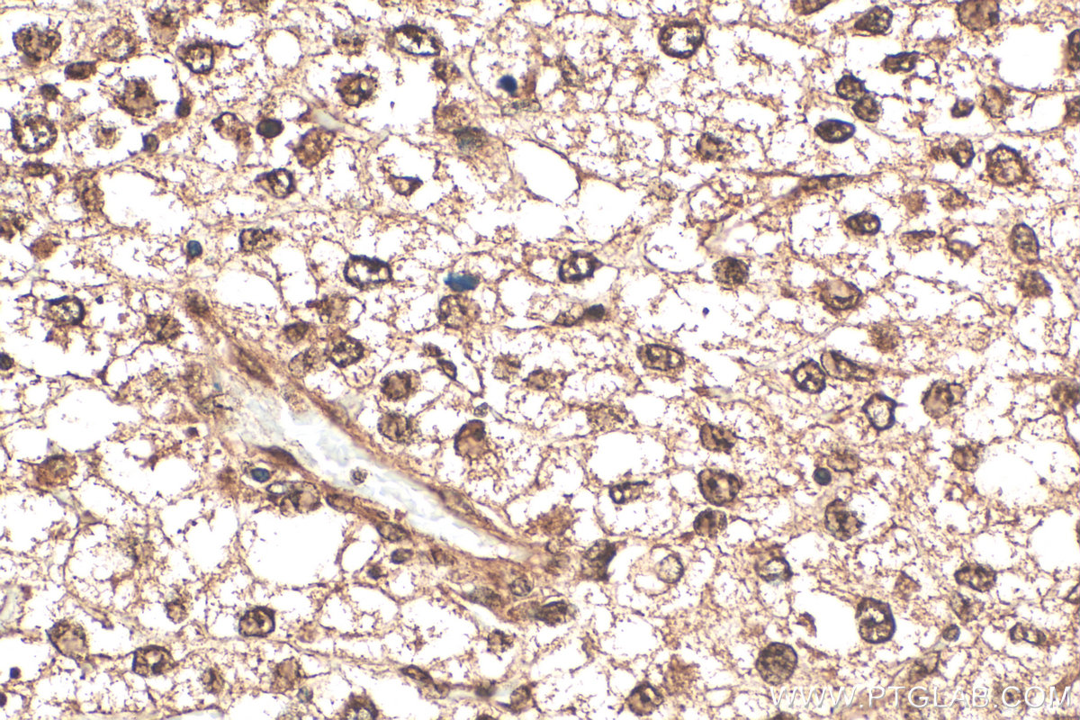 IHC staining of human pancreas cancer using 12230-2-AP