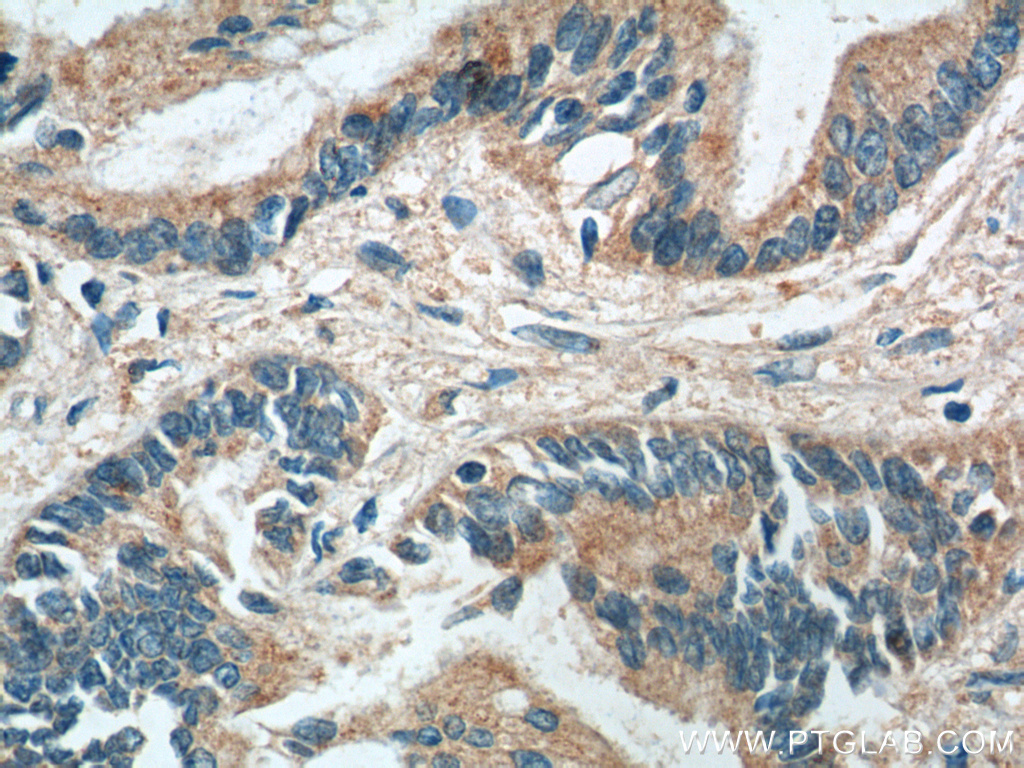 IHC staining of human pancreas cancer using 66015-2-Ig