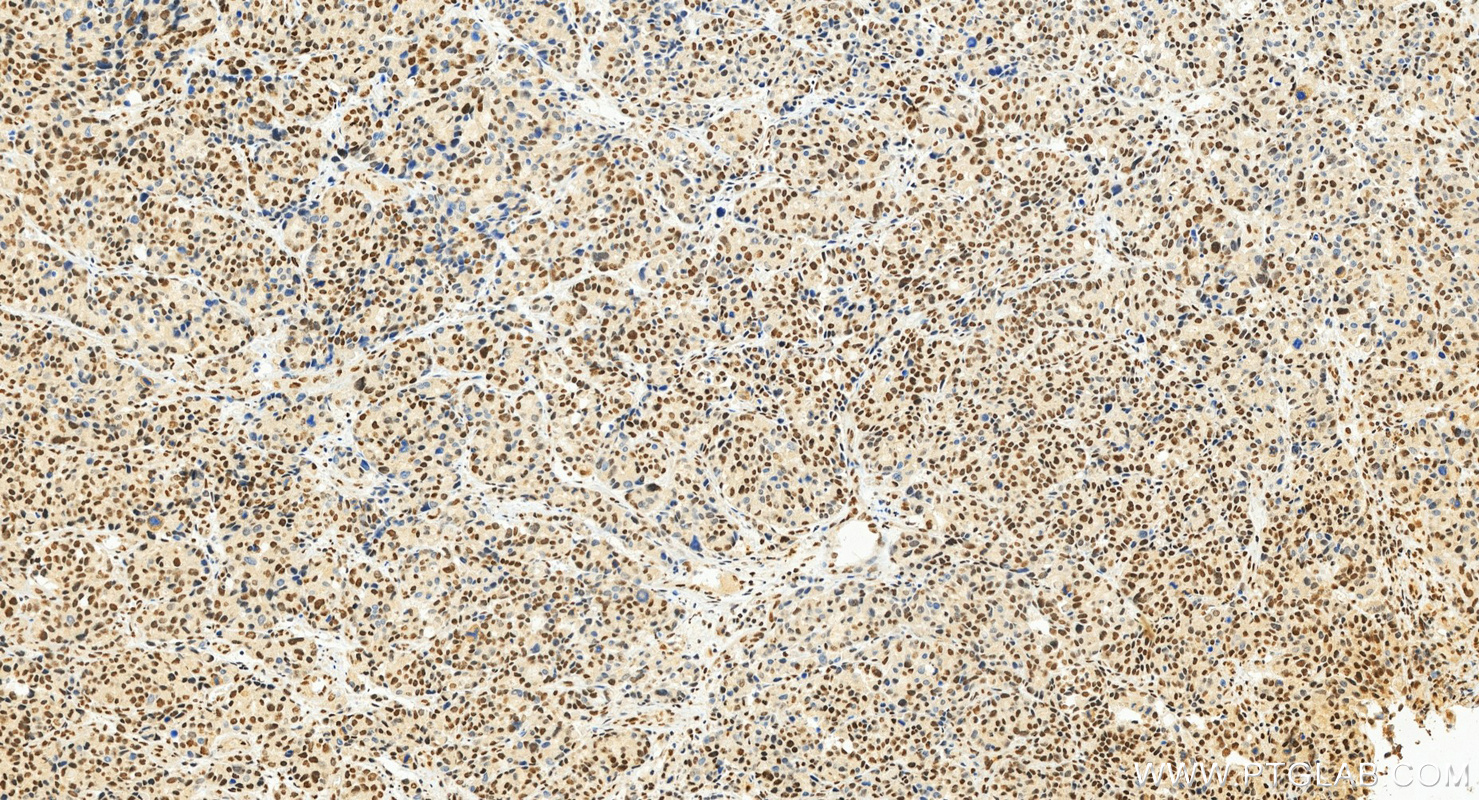 IHC staining of human stomach cancer using 10196-1-AP