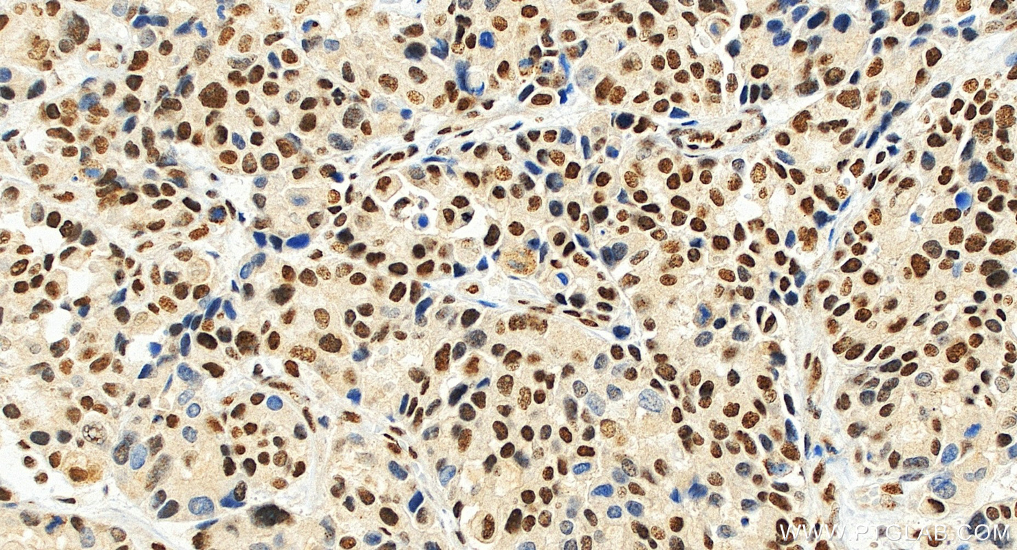 IHC staining of human stomach cancer using 10196-1-AP