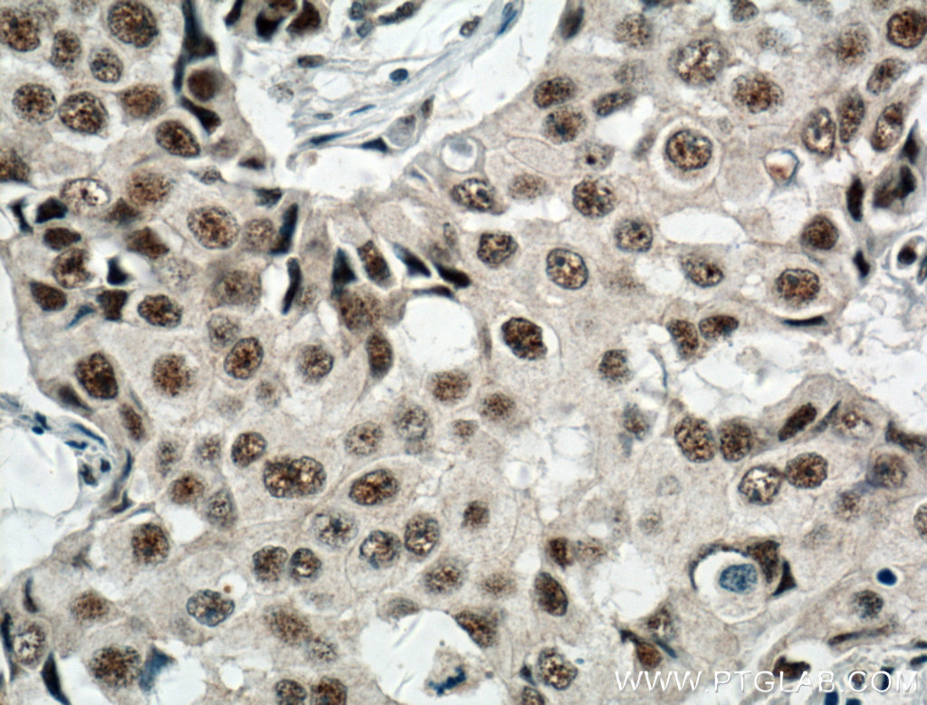 IHC staining of human breast cancer using 10587-1-AP