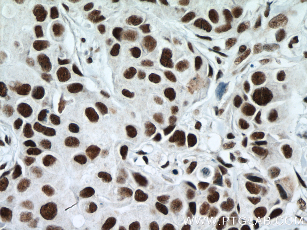 IHC staining of human breast cancer using 66059-1-Ig