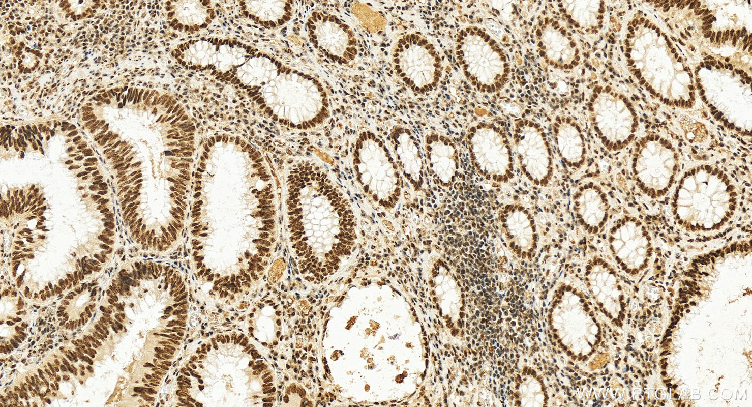 IHC staining of human colon cancer using 25297-1-AP