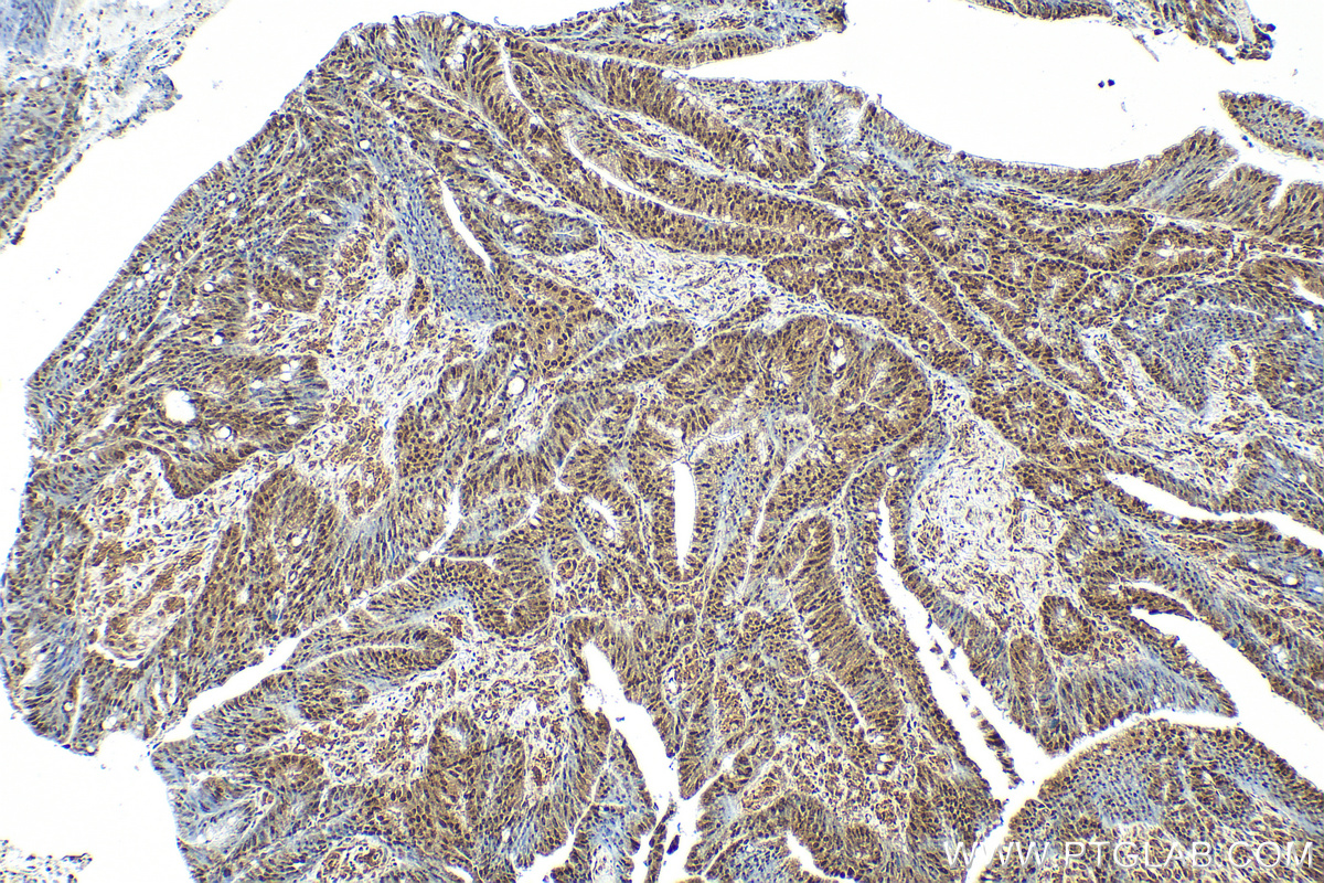 IHC staining of human colon cancer using RMX00066