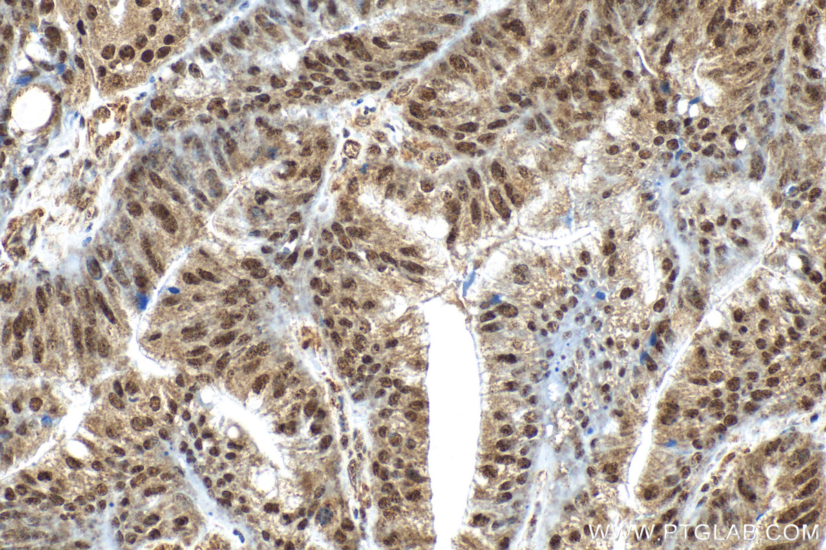 IHC staining of human colon cancer using RMX00066