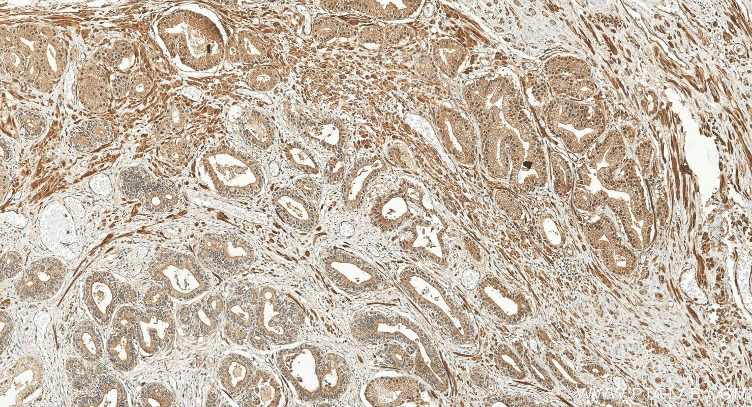 IHC staining of human prostate cancer using 31850-1-AP (same clone as 31850-1-PBS)