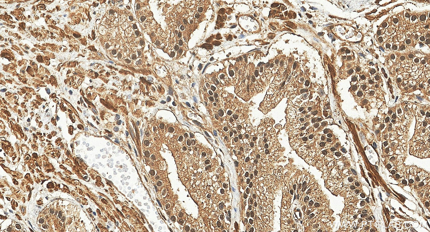 IHC staining of human prostate cancer using 31850-1-AP (same clone as 31850-1-PBS)