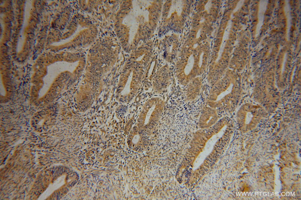 IHC staining of human endometrial cancer using 15784-1-AP