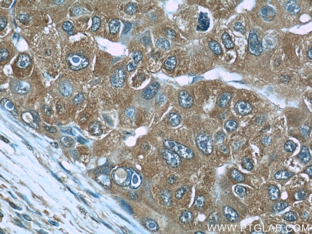 IHC staining of human liver cancer using 66104-1-Ig (same clone as 66104-1-PBS)