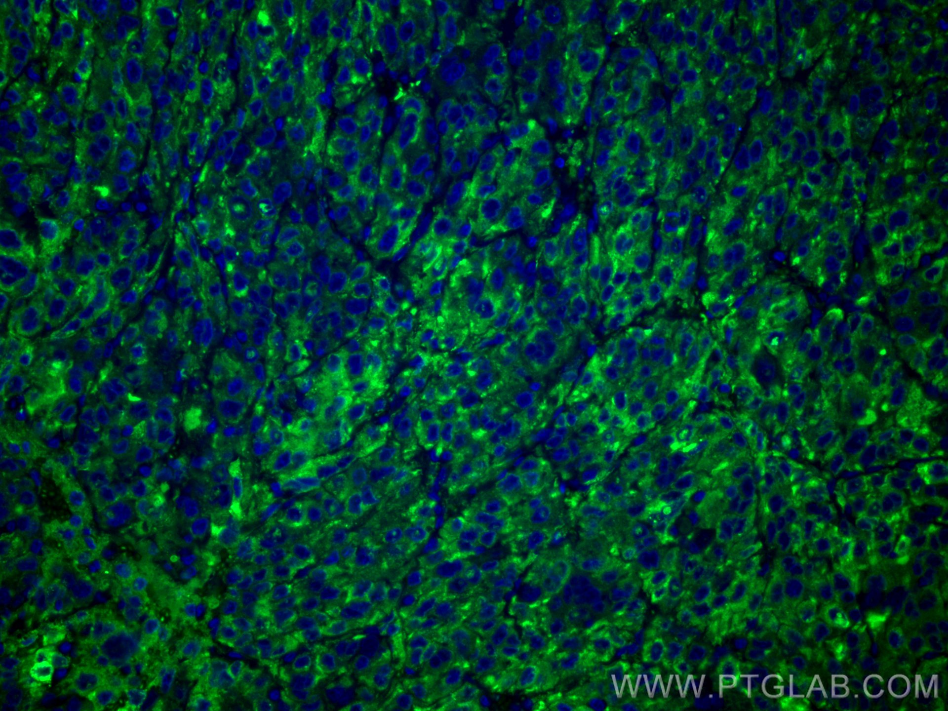 IF Staining of human liver cancer using CL488-66104