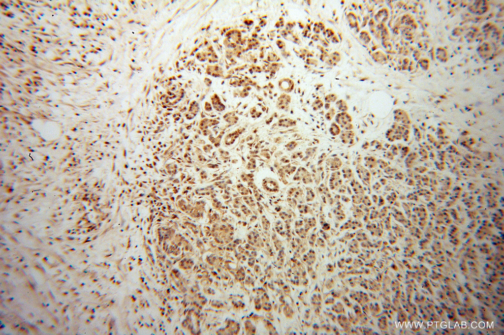 IHC staining of human pancreas cancer using 14613-1-AP