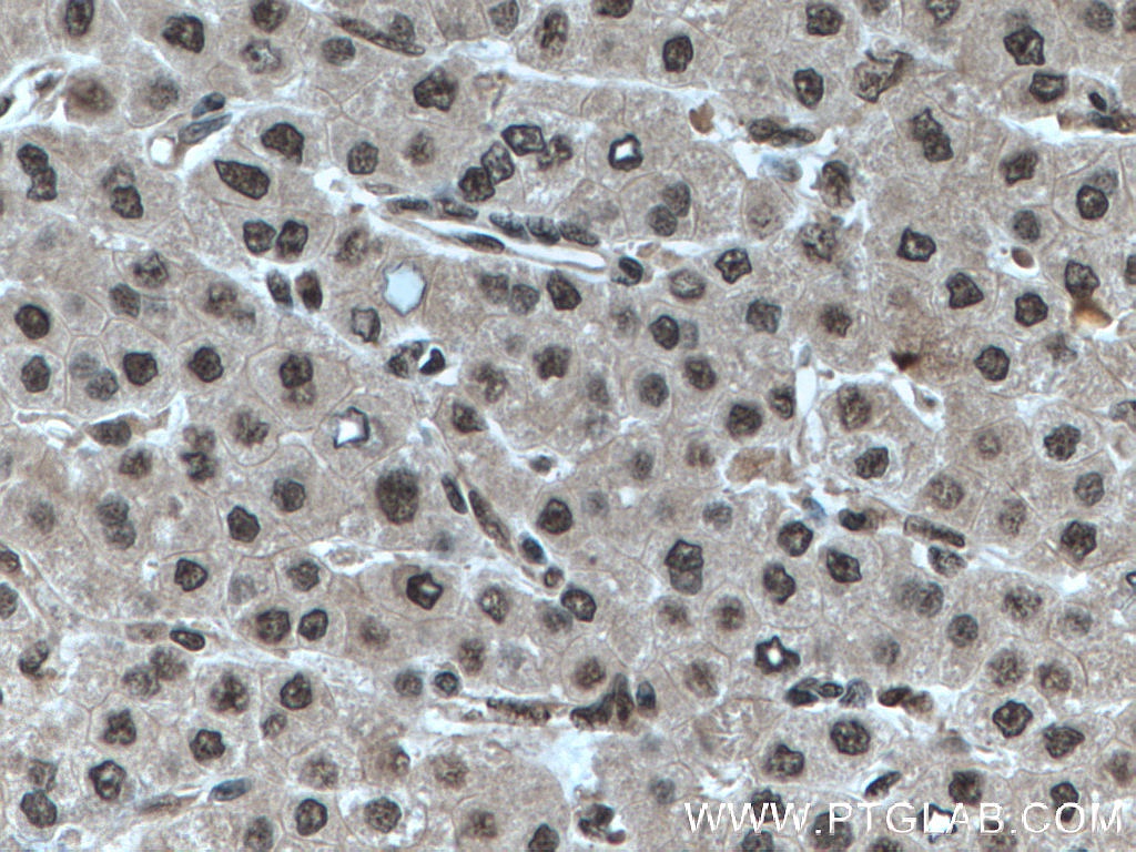 IHC staining of human liver cancer using 66716-1-Ig (same clone as 66716-1-PBS)