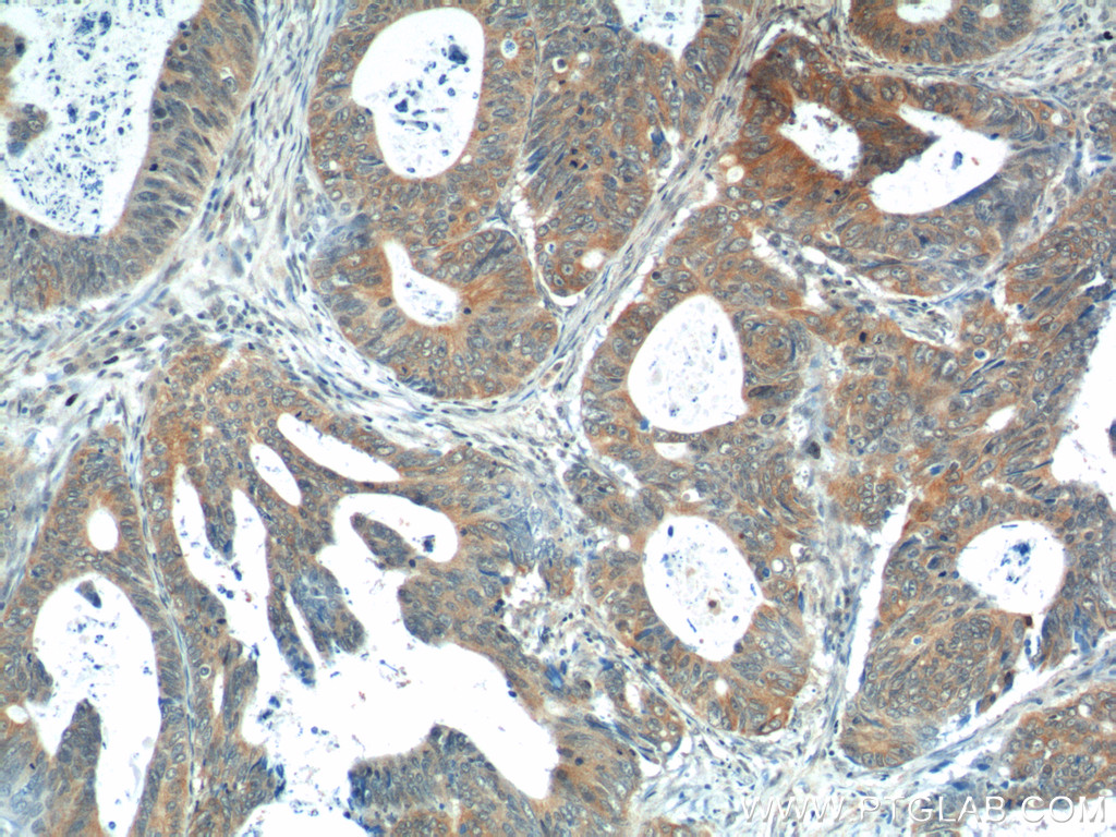 IHC staining of human colon cancer using 14869-1-AP