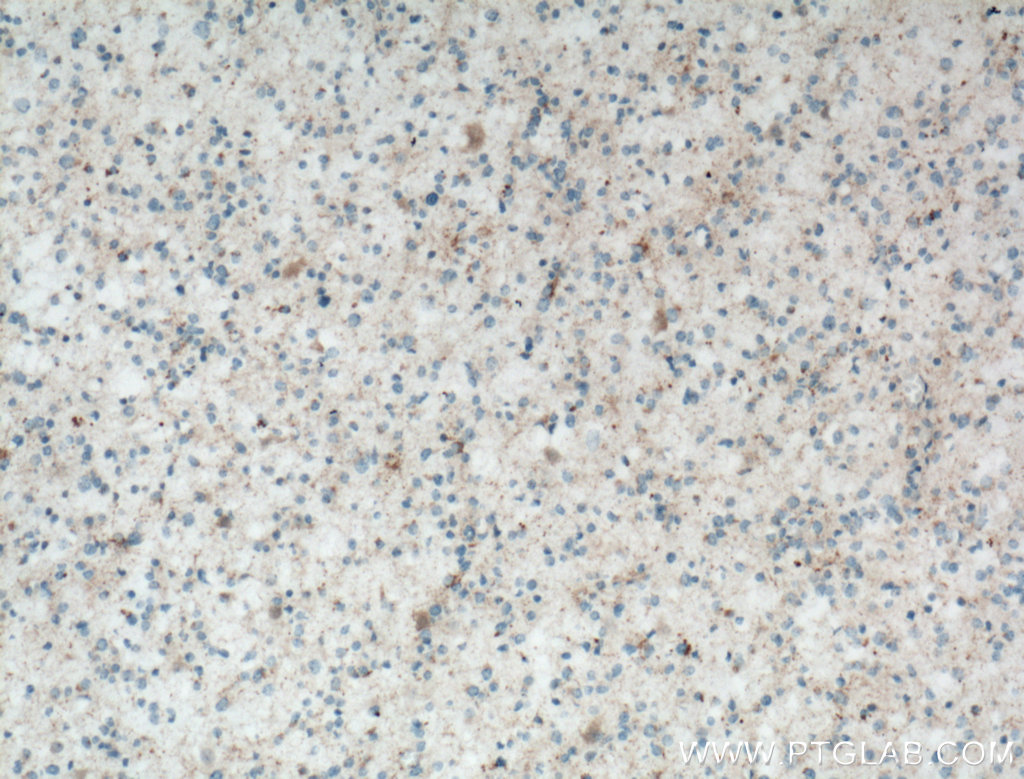 IHC staining of human gliomas using 12900-1-AP (same clone as 12900-1-PBS)