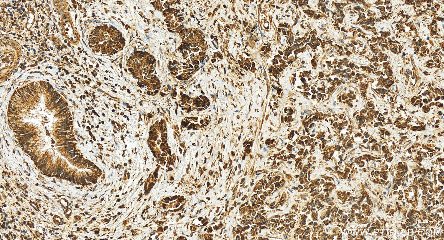 IHC staining of human intrahepatic cholangiocarcinoma using 24446-1-AP