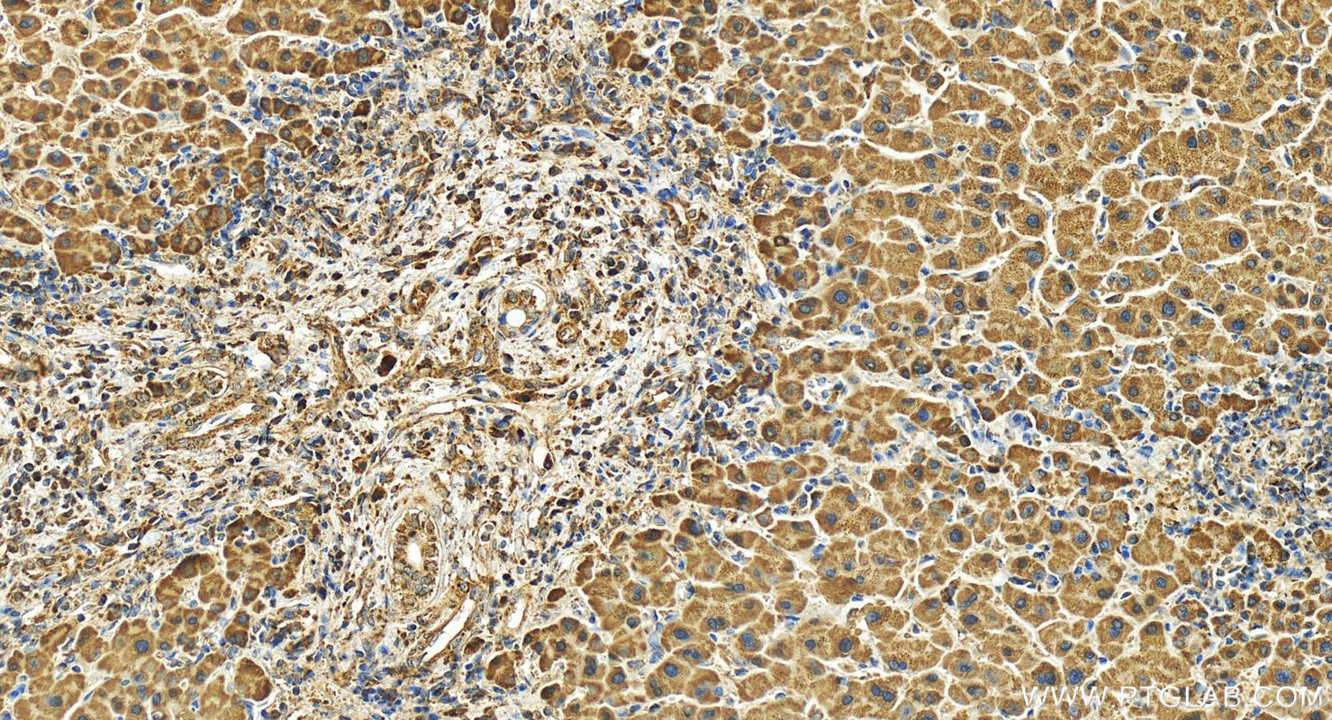 IHC staining of human intrahepatic cholangiocarcinoma using 24446-1-AP