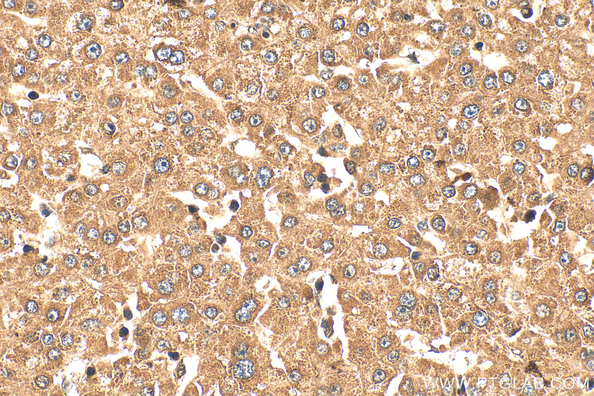 Immunohistochemical analysis of paraffin-embedded human liver cancer tissue slide using 24446-1-AP (RCCD1 antibody) at dilution of 1:200 (under 40x lens). Heat mediated antigen retrieval with Tris-EDTA buffer (pH 9.0). IHC staining of human liver cancer using 24446-1-AP