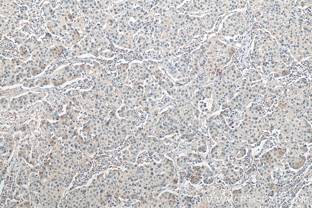 IHC staining of human breast cancer using 67856-1-Ig