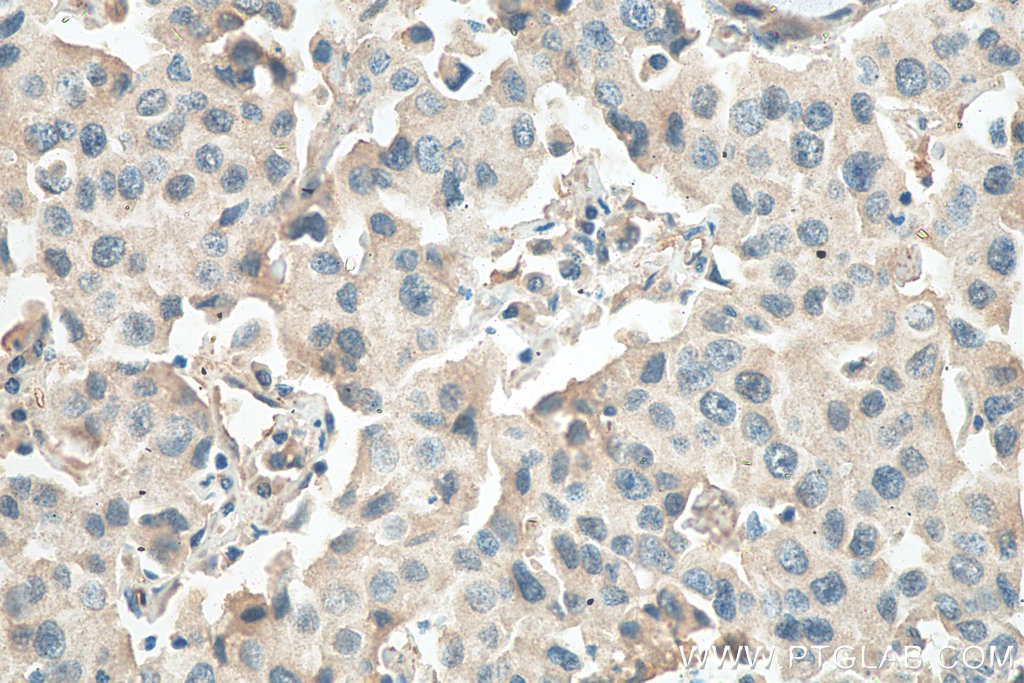 IHC staining of human breast cancer using 67856-1-Ig