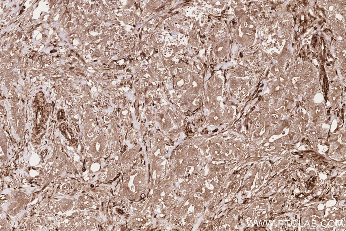 IHC staining of human rectal cancer using 14855-1-AP