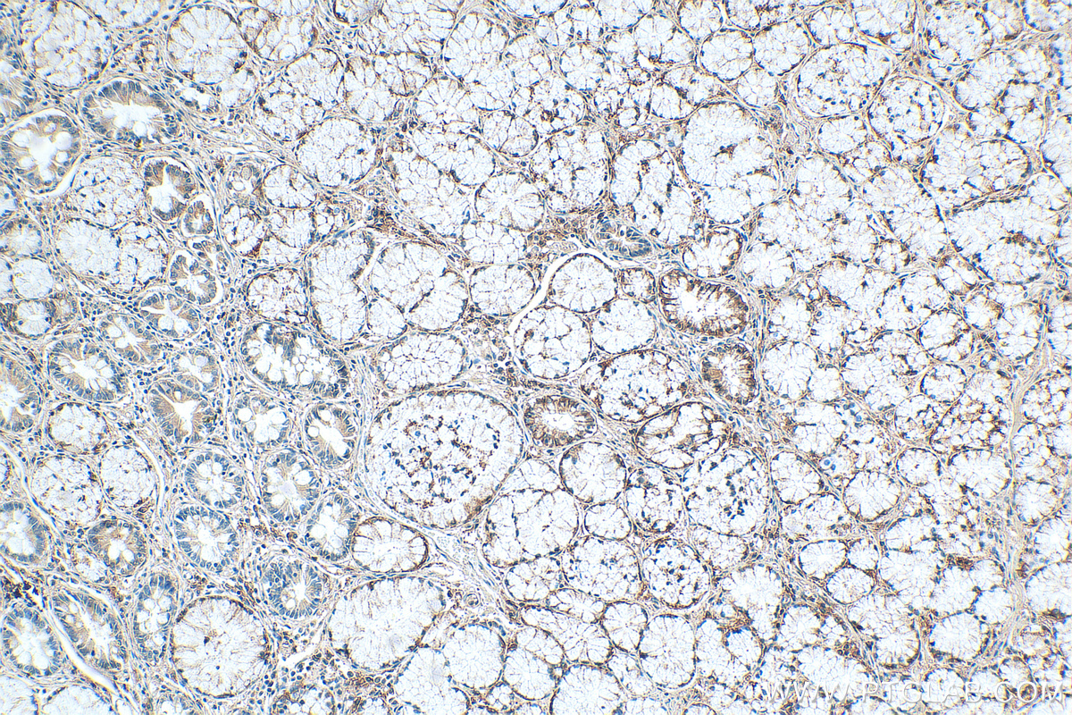 IHC staining of human stomach cancer using 68540-1-Ig