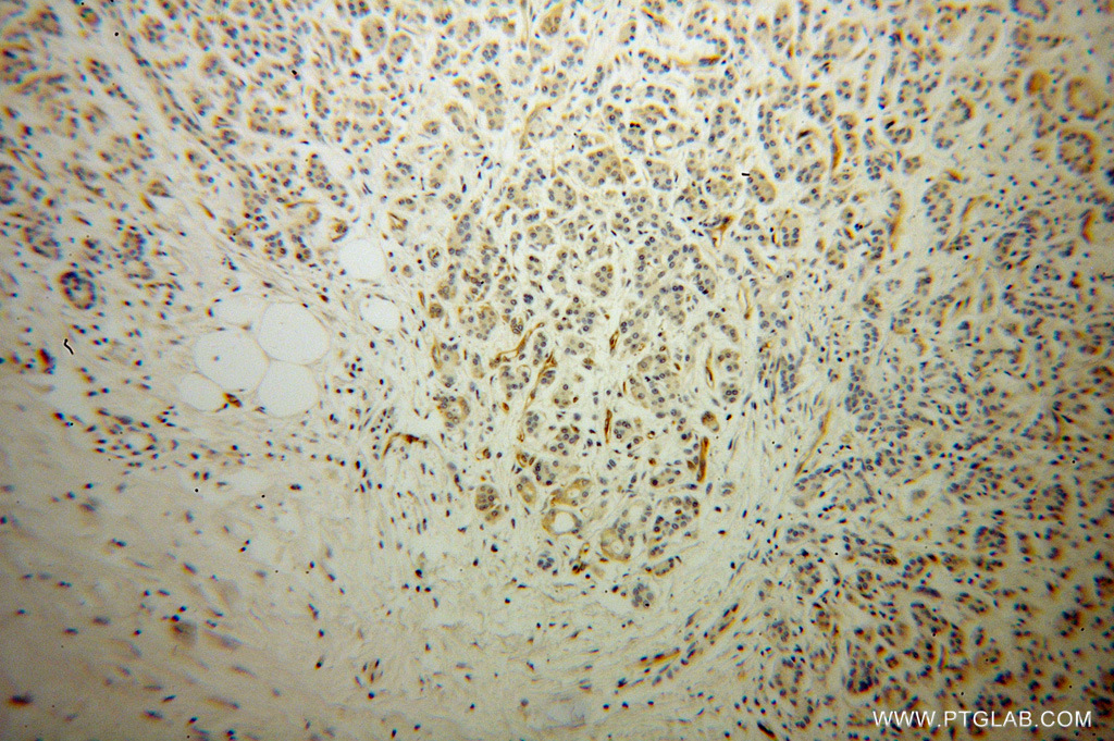 IHC staining of human pancreas cancer using 13790-1-AP