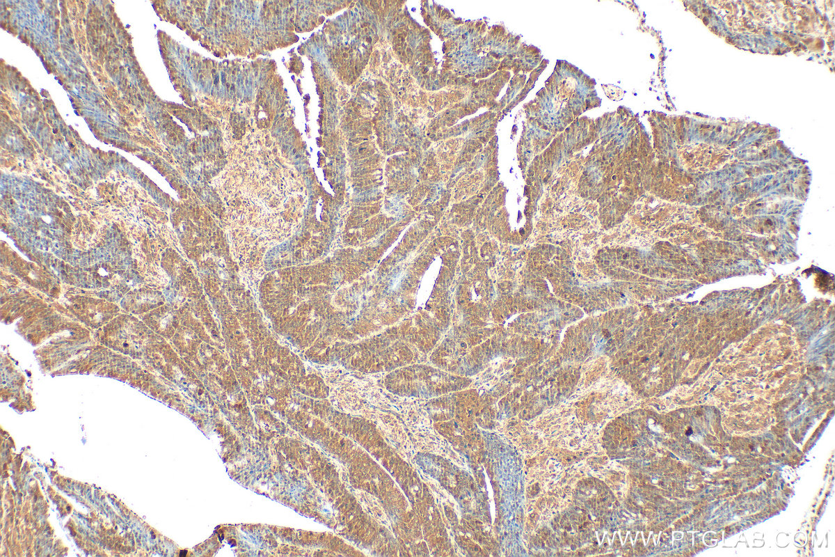 IHC staining of human colon cancer using 17008-1-AP