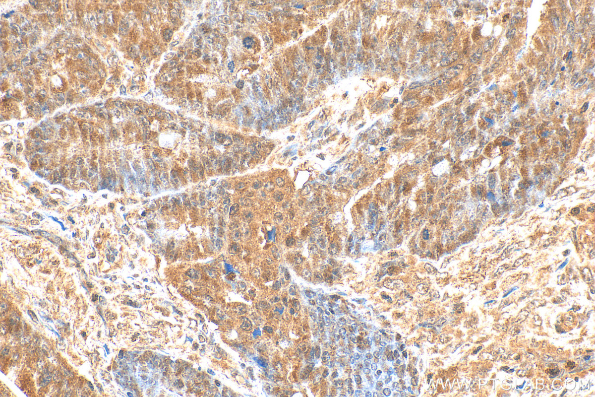 IHC staining of human colon cancer using 17008-1-AP