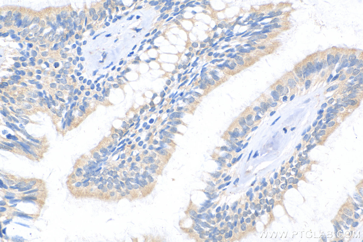 IHC staining of human lung cancer using 10638-1-AP