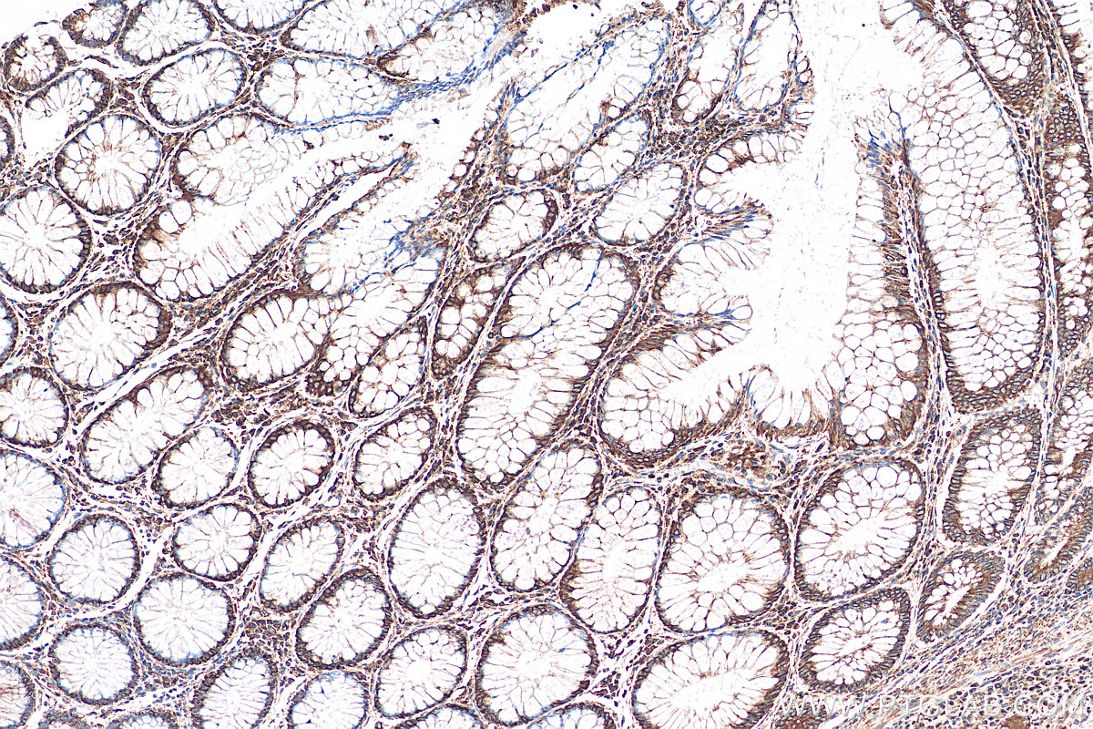 IHC staining of human colon cancer using 14643-1-AP