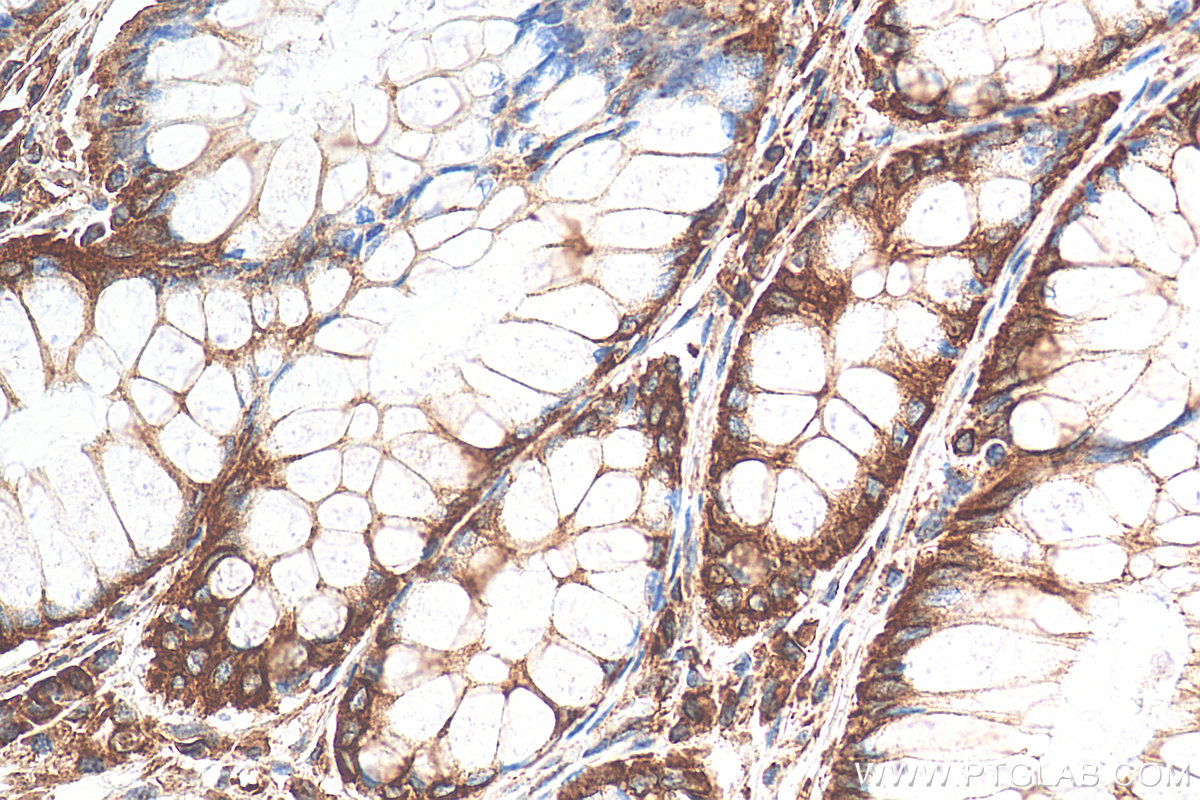 IHC staining of human colon cancer using 14643-1-AP
