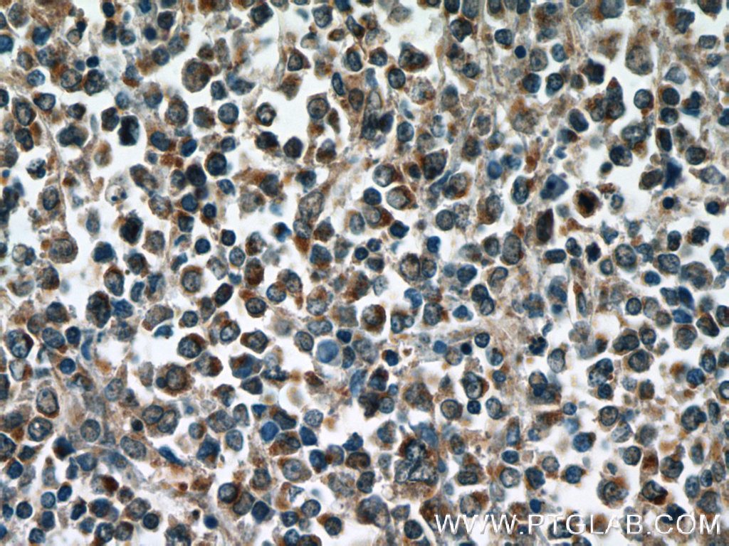 IHC staining of human lymphoma using 25027-1-AP