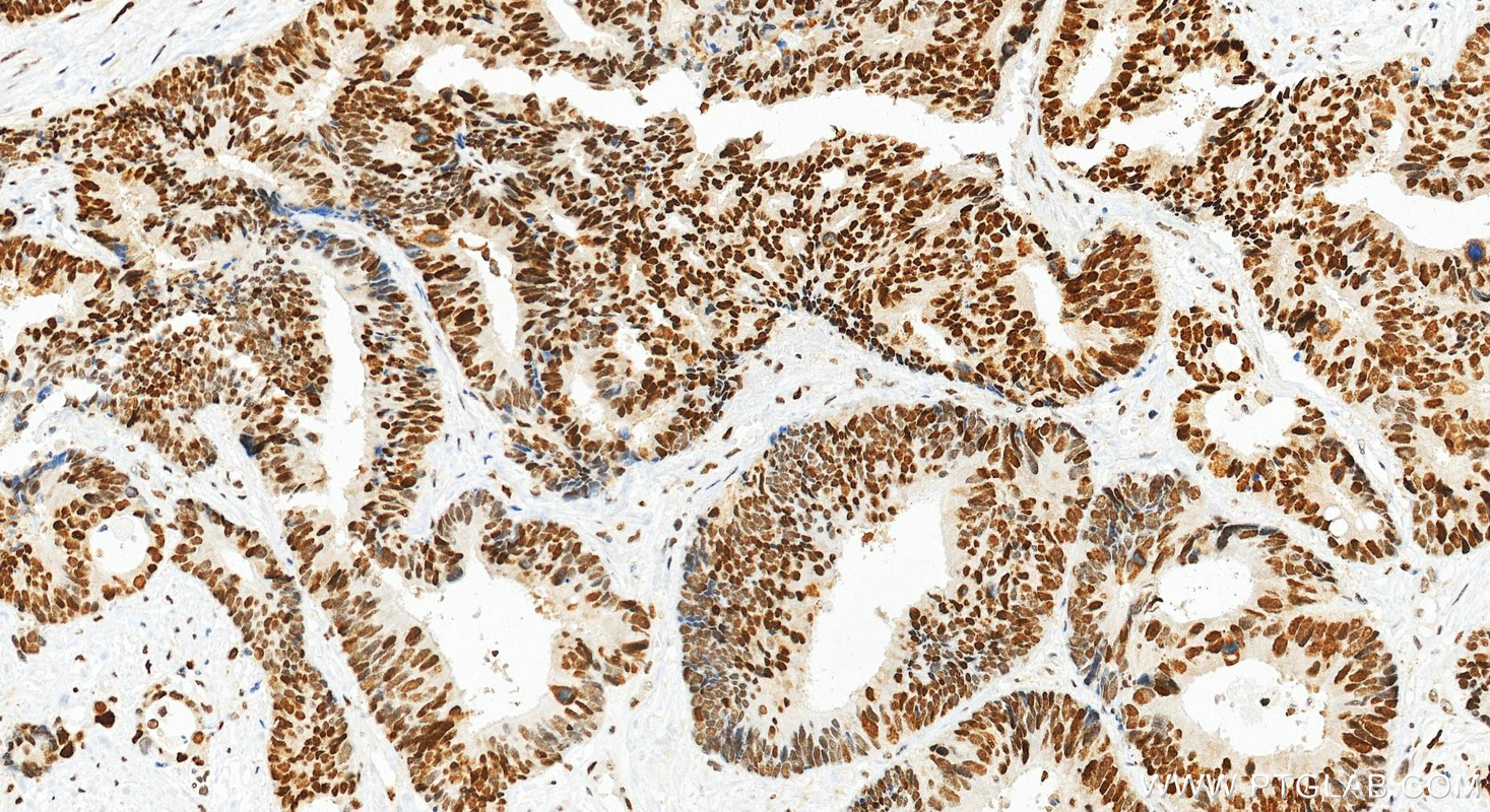 IHC staining of human colon cancer using 84892-1-RR